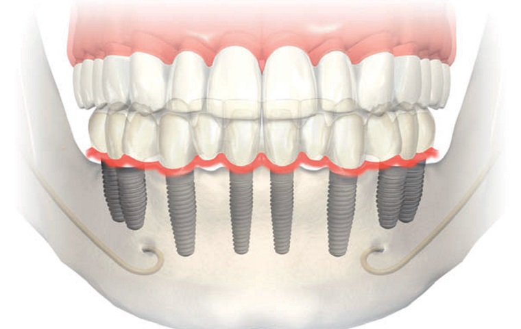 Dentadura Fixa